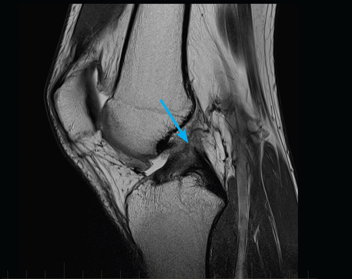 Knee Acl And Meniscal Injuries Adult Mri Series Gp Referred Items