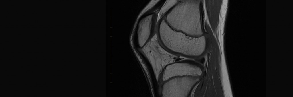 Mri Scan Paediatric Knee Melbourne Radiology Mri At Melbourne