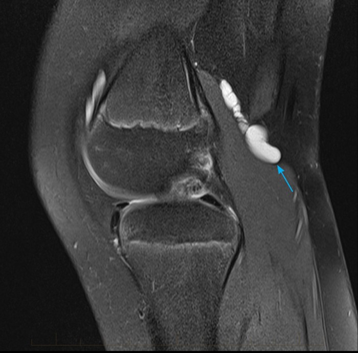 Paediatric Mri Scan Knee Bakers Cyst Mri At Melbourne Radiology Clinic