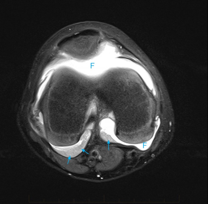 Juvenile Chronic Arthritis Mri Knee Mri At Melbourne Radiology Clinic