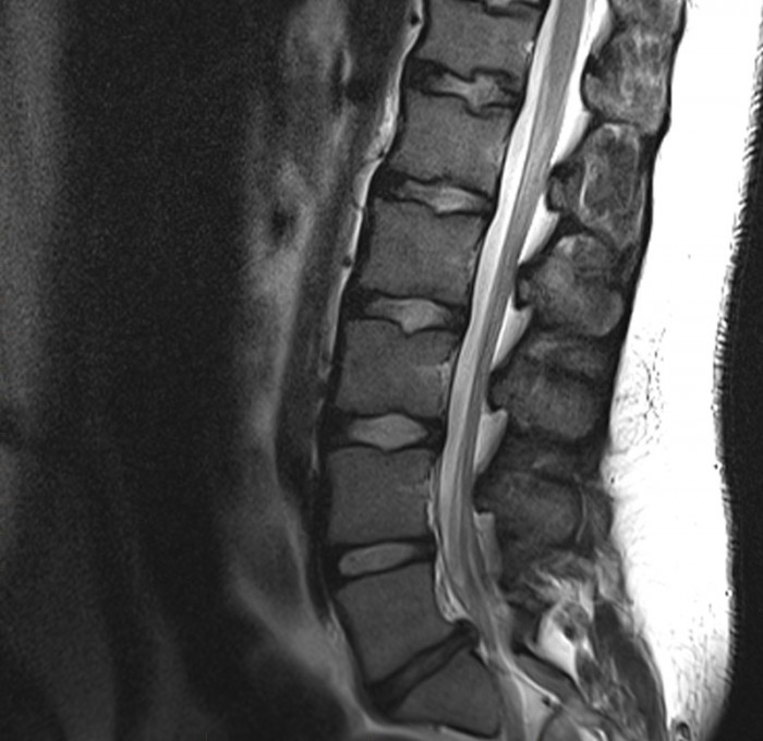 Paediatric Mri Spine Sciatica Mri At Melbourne Radiology Clinic