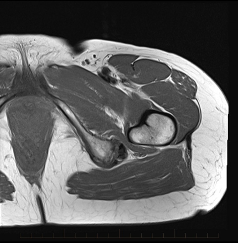 MRI Hamstring bursitis - MRI at Melbourne Radiology Clinic