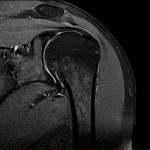 MRI of Shoulder - Rotator cuff tear