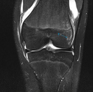 10-paediatric-mri-scan-knee-patellar-dislocation - MRI at Melbourne ...