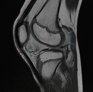 11-juvenile-chronic-arthritis-mri-knee - Mri At Melbourne Radiology Clinic