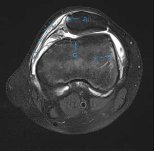 9-paediatric-mri-scan-knee-patellar-dislocation-3 - Mri At Melbourne 